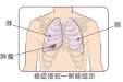 肺癌的手术治疗