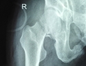 骨盆加股骨颈骨折2