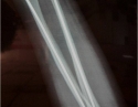儿童尺桡骨双骨折术后8个月骨折愈合片