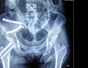 骨盆加股骨颈骨折5