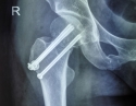 骨盆加股骨颈骨折4