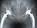 保留股骨颈的全髋关节置换术