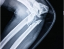 肘关节复杂骨折1