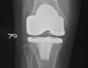 膝关节表面置换