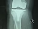 膝关节感染后翻修1