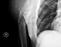 肩关节巨大恶性肿瘤的Tikhoff-linberg保肢术