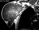 肩关节巨大恶性肿瘤的Tikhoff-linberg保肢术