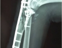 肘关节复杂骨折2