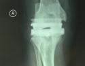 膝关节感染后翻修4