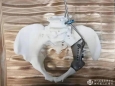 四川观察：盆骨也能“私人定制” 省医院完成3D打印半骨盆手术