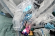 机器人微创中心完成西部首例单孔机器人前列腺癌根治术