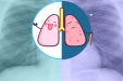 肺上长结节是不是就“癌”起了？