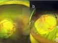 多学科联合完成首例视网膜母细胞瘤超选眼动脉介入灌注化疗
