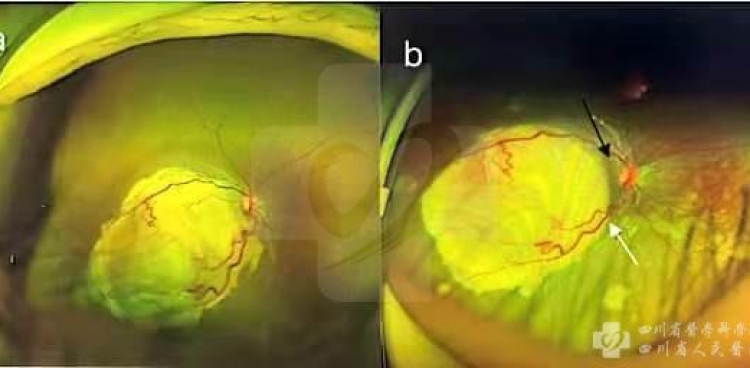 多学科联合完成首例视网膜母细胞瘤超选眼动脉介入灌注化疗