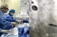 集团崇州医院成功开展无导线心脏起搏器植入手术