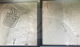 我院成功开展首例心脏收缩力调节器植入手术